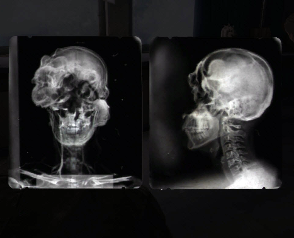 Ảnh chụp X quang hộp sọ một bệnh nhân nhiễm nấm